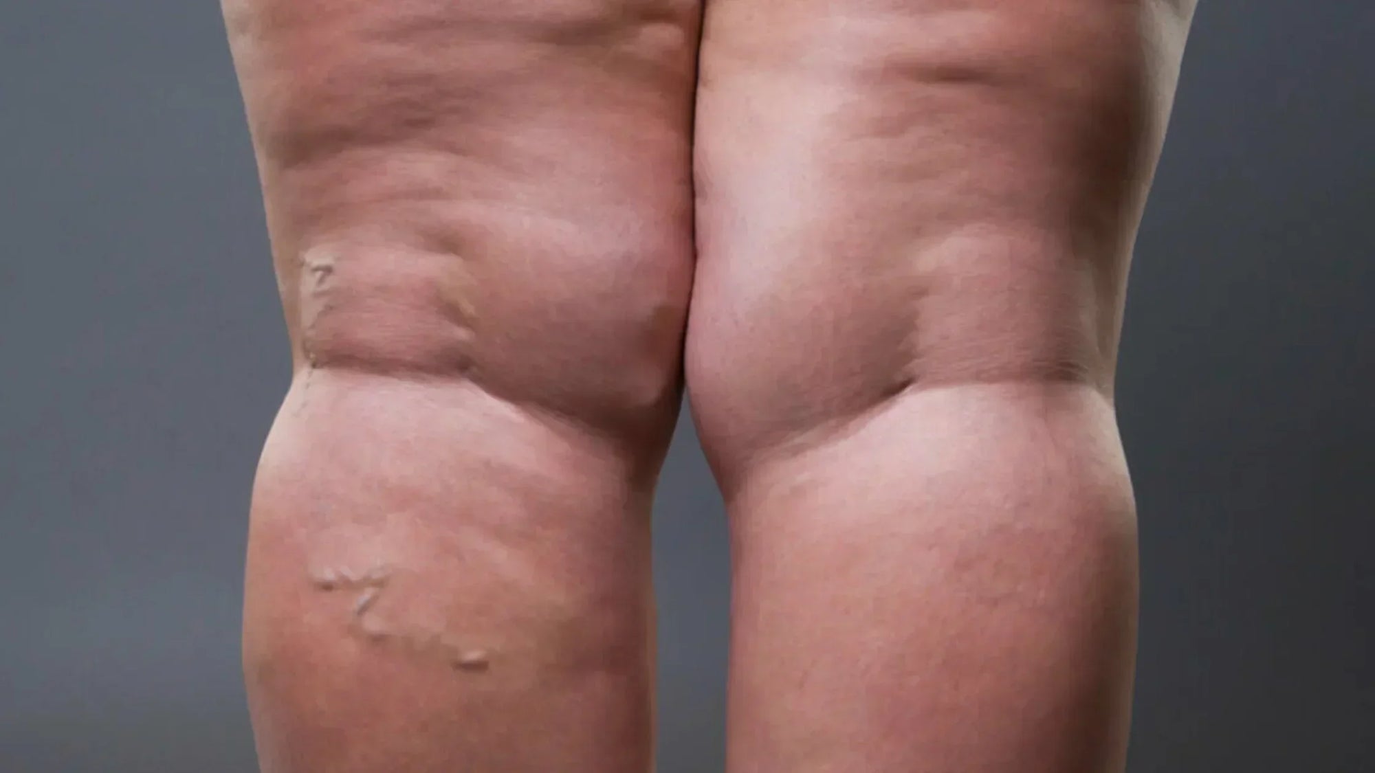 Lipedema and how glo910 can help