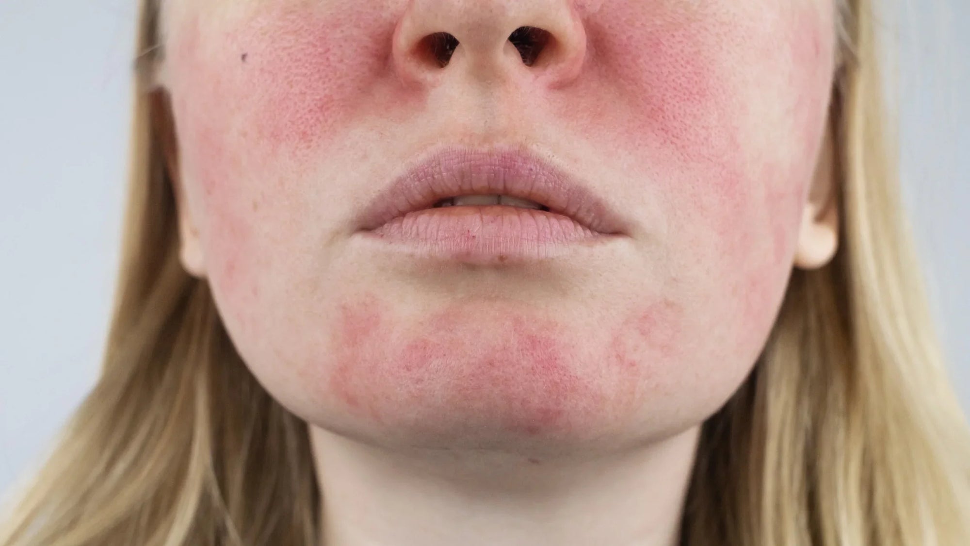 Woman with rosacea