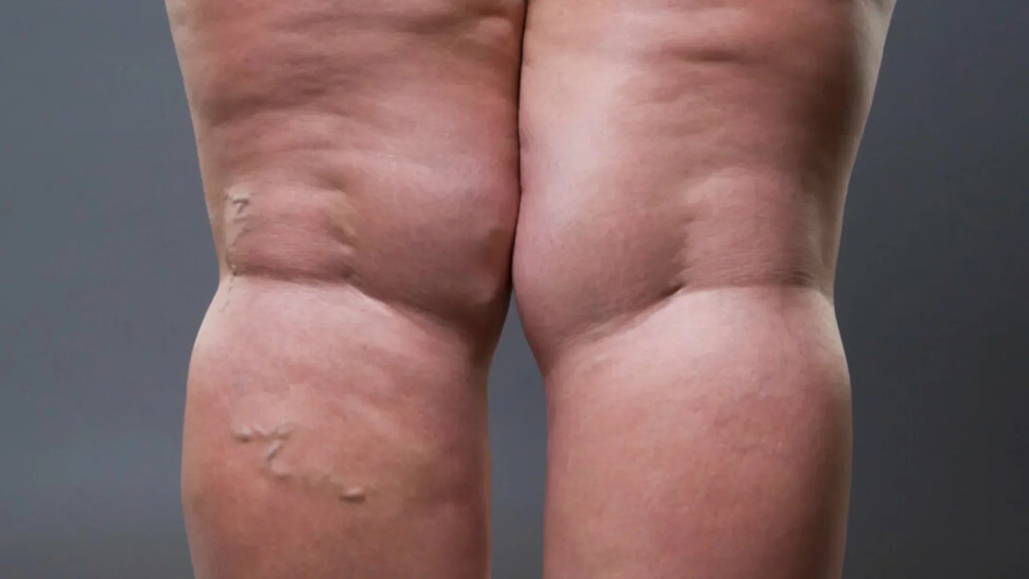 Lipedema and how glo910 can help