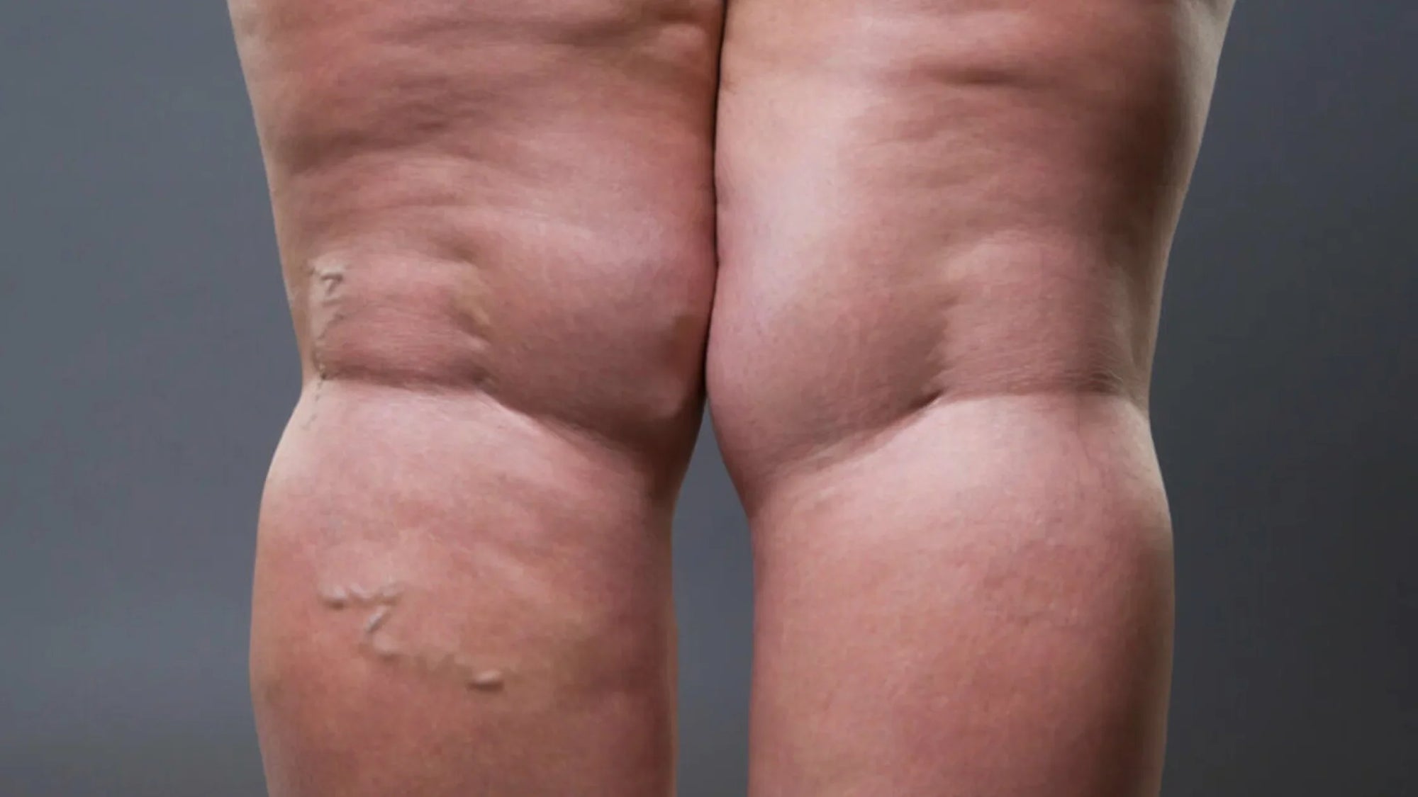 Lipedema and how glo910 can help