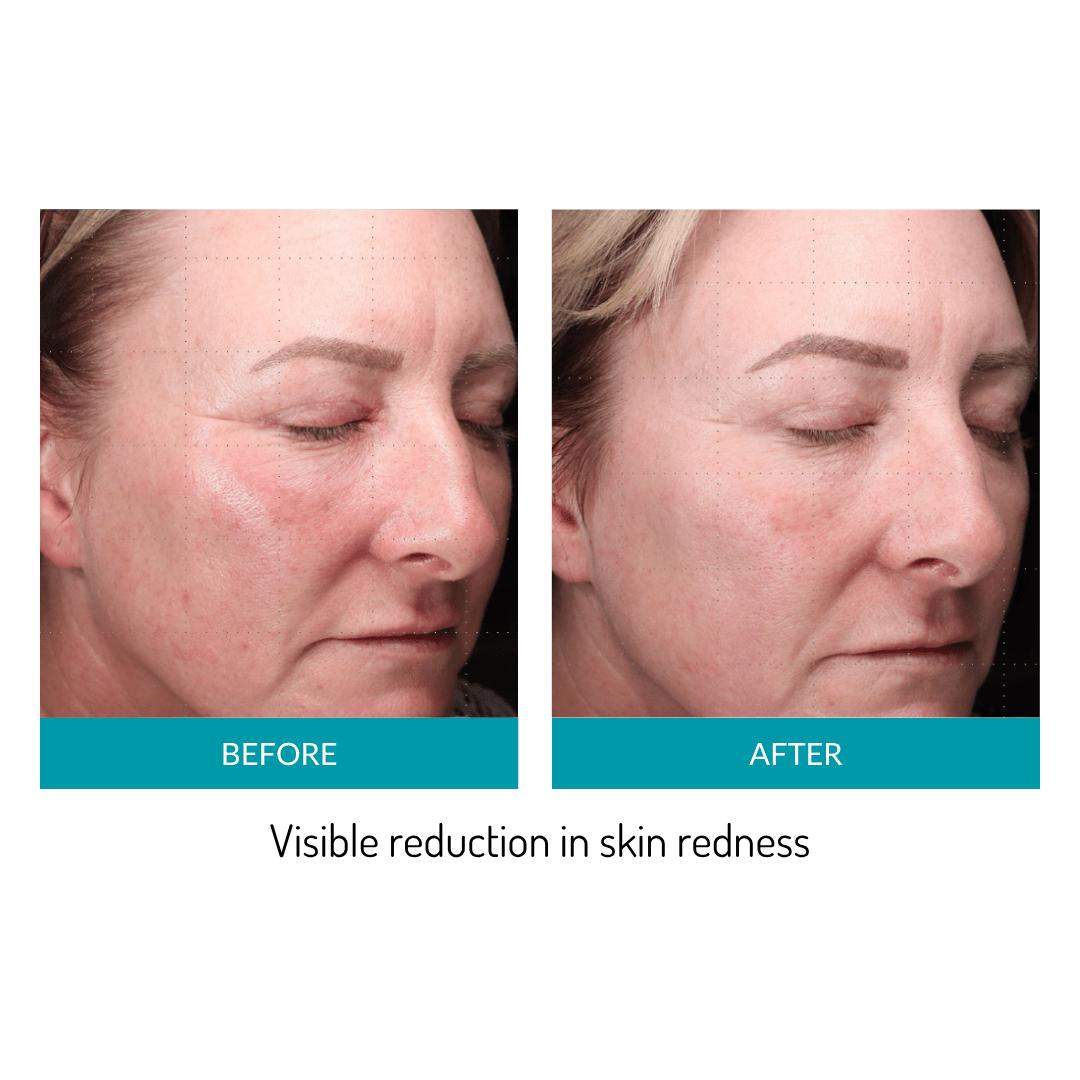 Glo Mask Anti-Aging LED Phototherapy Mask