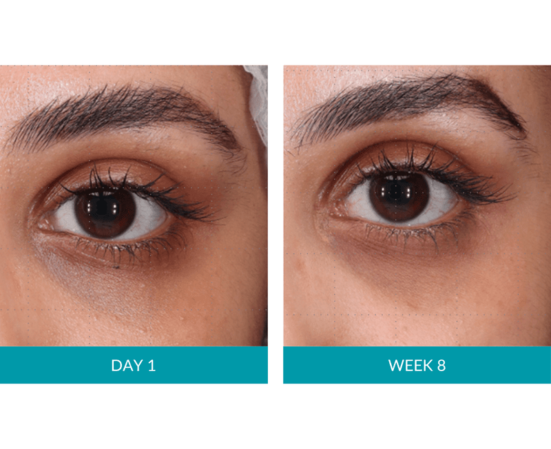 46% notice improvement in eye bags