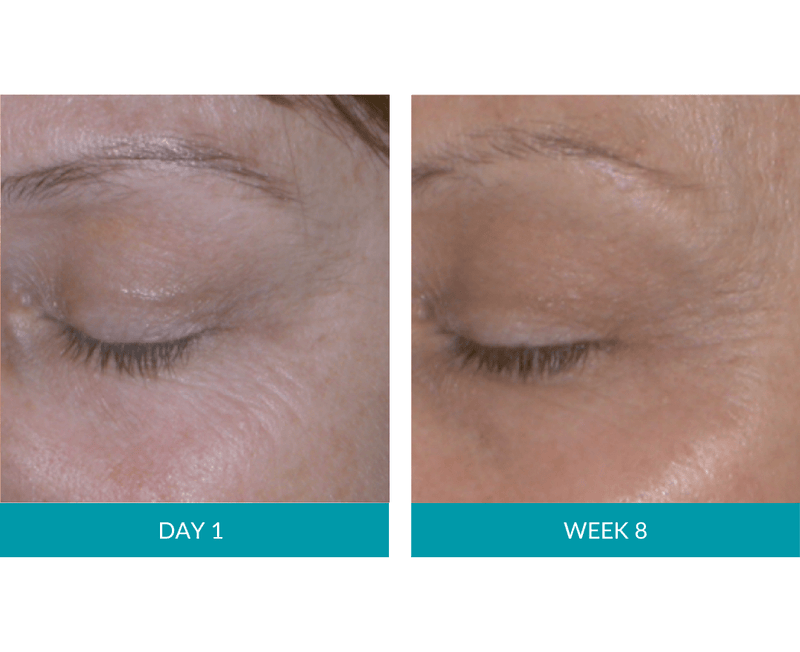 57% record improved wrinkle reduction